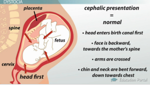 Cephalic presentation at 24 weeks picture